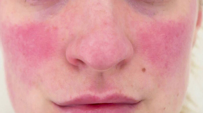 آکنه-روزاسه-(acne-rosacea)